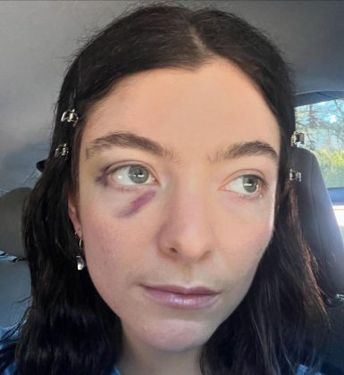 A artista não comentou sobre a origem da lesão, o que deixou os fãs intrigados. (Imagem: instagram lorde)