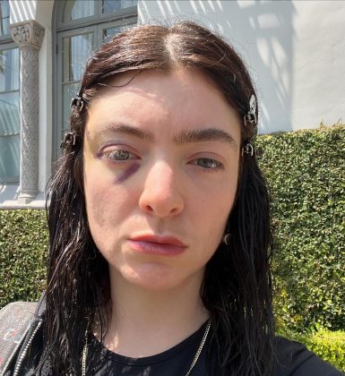 Nas imagens, ela exibe um hematoma visível ao redor do olho. (Imagem: instagram lorde)