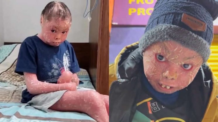 Nicolas Gomes, um menino de 12 anos de Betim, Minas Gerais, foi diagnosticado ao nascer com ictiose lamelar, uma condição genética rara que causa o espessamento e a descamação severa da pele. (Foto: Instagram)