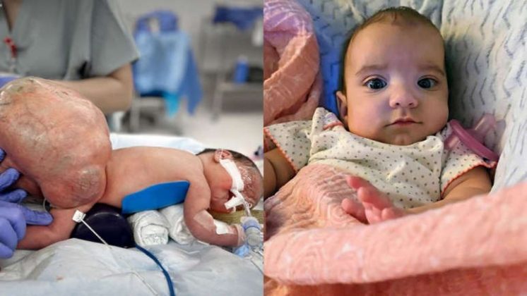 Bebê sobrevive após nascer com tumor raro de quase 2 kg (Foto: Texas Children’s Women’s Pavilion)