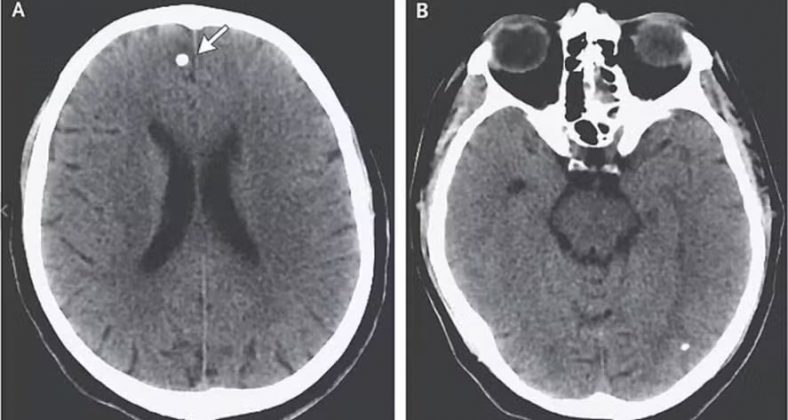 Um dos graves problemas no cérebro é a cisticercose (Foto: Reprodução)