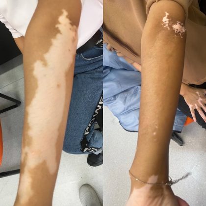 Especialistas acreditam que as dificuldades emocionais contribuíram para o agravamento do vitiligo. (Imagem: reprodução Instagram)