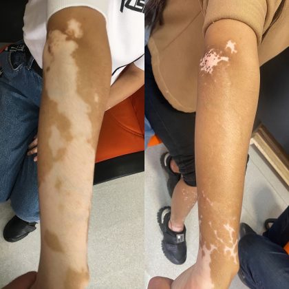 Homem com 98% da pele afetada por vitiligo teve melhora após divórcio. (Imagem: reprodução Instagram)