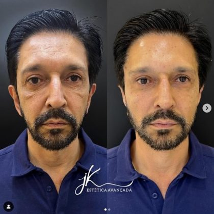 O prefeito Ricardo Nunes realizou harmonização facial. (Imagem: reprodução instagram)