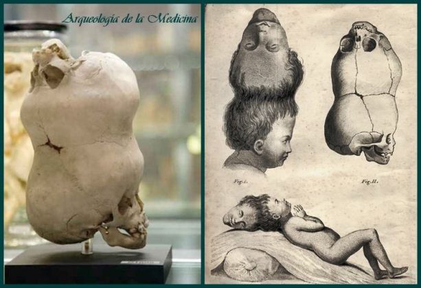 Na Índia, há cerca de 240 anos, um menino nasceu com uma condição rara chamada craniopagus parasiticus (Foto: Reprodução/Hunterian Museum de Londres)