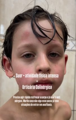 Murilo Antônio, de 7 anos, enfrenta uma batalha diária contra a urticária colinérgica, uma reação alérgica ao suor e ao calor (Foto: Reprodução/Instagram/@jheniveronica)