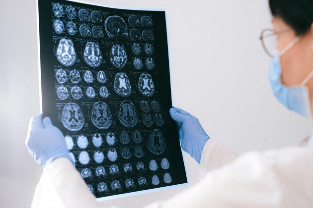 Alzheimer: saiba qual o novo tipo de genético descoberto da doença. (Foto: Pexels)