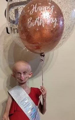 Apesar das adversidades, ela desafiou as probabilidades. Enquanto a expectativa média de vida para pessoas com progeria é de apenas 14 anos, Beandri conseguiu viver até os 19 (Foto: Reprodução/Facebook)