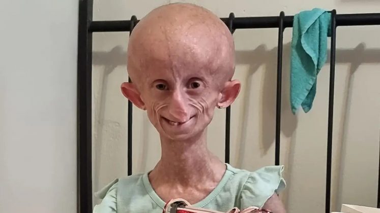 A jovem Beandri Booysen, de Pretória, na África do Sul, enfrentava uma condição rara chamada síndrome de progeria de Hutchinson-Gilford (Foto: Reprodução/Facebook)