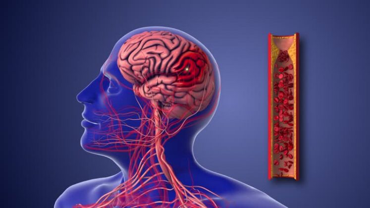 AVC precoce pode ter risco aumentado pelo tipo sanguíneo, diz pesquisa. (Foto: iStock)
