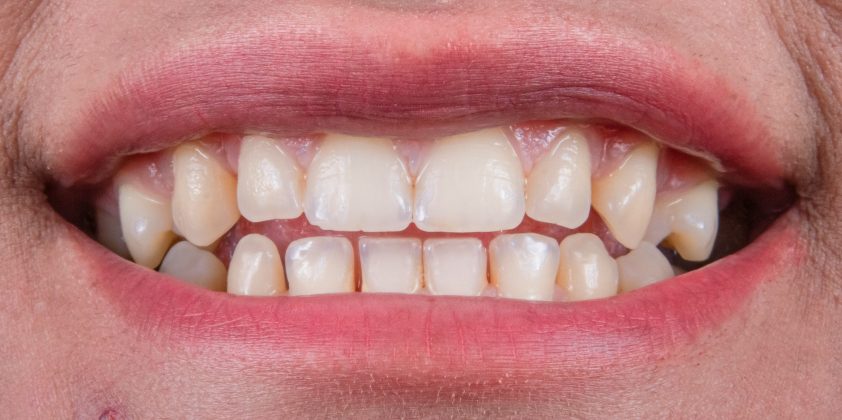 Pesquisadores no Japão iniciaram os primeiros testes clínicos de um medicamento que pode estimular o crescimento de dentes humanos, um avanço que promete transformar os tratamentos odontológicos (Foto: Unsplash)