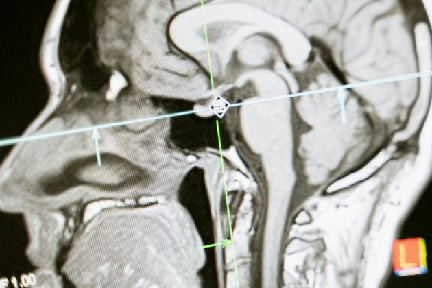 A pesquisa revelou que altos índices de desigualdade social estão relacionados à redução do volume do cérebro e à diminuição da conectividade cerebral, principalmente nas regiões temporo-cerebelar, fronto-talâmica e hipocampal, associadas à memória (Foto: Pexels)