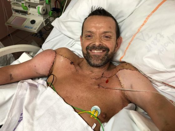 Este homem islandês foi o 1º paciente do mundo a receber um transplante duplo de braço e ombro (Foto: Reprodução/Instagram)