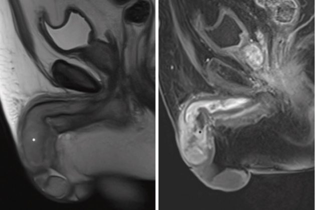 Exame de imagem mostrou que o tumor já havia dominado toda a extensão do pênis (Foto: Reprodução)