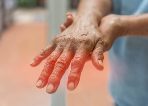 O lúpus, que é uma doença autoimune que causa uma inflamação nos órgãos e articulações, afeta o movimento e a pele, e em quadros mais graves, pode ser fatal, quando não tratada. (Foto: iStock)