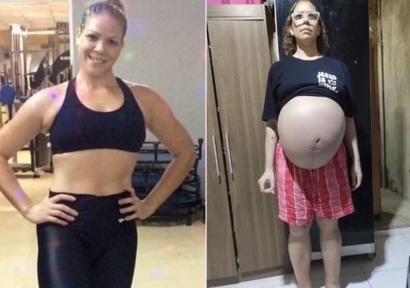 Mulher descobre miomas uterinos gigantes de 12 kg: "Todo mundo achava que eu estava grávida" (Foto: Reprodução/Revista Crescer)