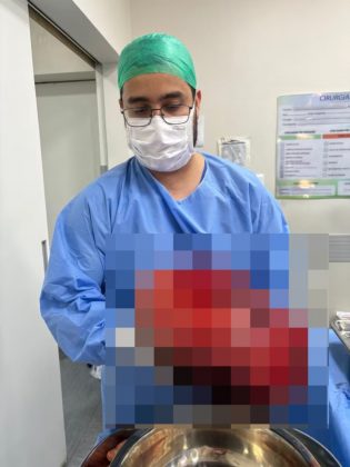 A luta de Grazielle pela preservação da saúde e de seus sonhos se concretizou em janeiro de 2024, quando a cirurgia foi realizada com sucesso, retirando 12 miomas, e ela não precisou perder o útero (Foto: Reprodução/Revista Crescer)