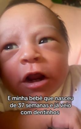 O fenômeno é raro, já que, normalmente, os dentes só começam a aparecer entre seis e doze meses de idade (Foto: Reprodução/TikTok)