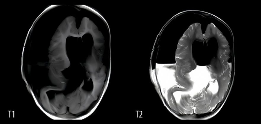 O caso de uma bebê chinesa, que nasceu com um feto dentro do cérebro, deixou os médicos perplexos (Foto: American Journal of Case Reports)