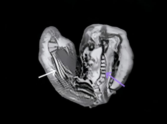 A ressonância magnética revelou que o feto tinha cerca de 18 centímetros, com braços, cabelos e até olhos. Inicialmente, pensaram tratar-se de um tumor, mas exames mais detalhados confirmaram que era um feto malformado (Foto: American Journal of Case Reports)