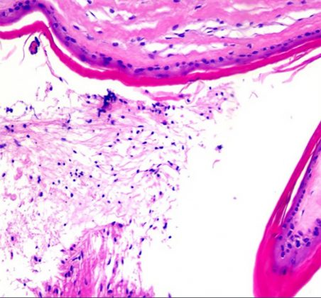 A condição é chamada de fetus in fetu, uma anomalia rara. Esse fenômeno ocorre quando um resquício de embrião ou feto se desenvolve dentro do corpo do irmão gêmeo, geralmente no abdômen. Porém, casos em que o feto se aloja no cérebro são extremamente raros, com apenas 20 registros conhecidos (Foto: American Journal of Case Reports)