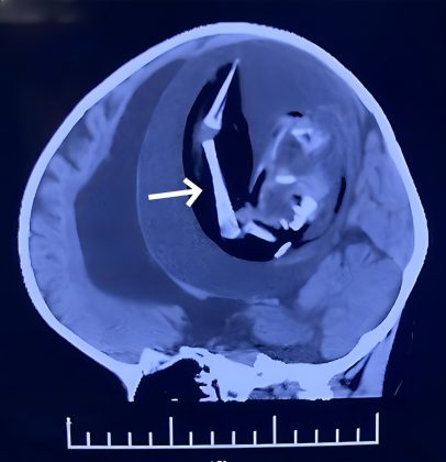 Após apresentar atrasos no desenvolvimento motor e de fala, os pais notaram que algo estava errado. Exames de rotina revelaram a presença do feto de seu irmão gêmeo falecido durante a gestação, armazenado no cérebro da criança (Foto: American Journal of Case Reports)