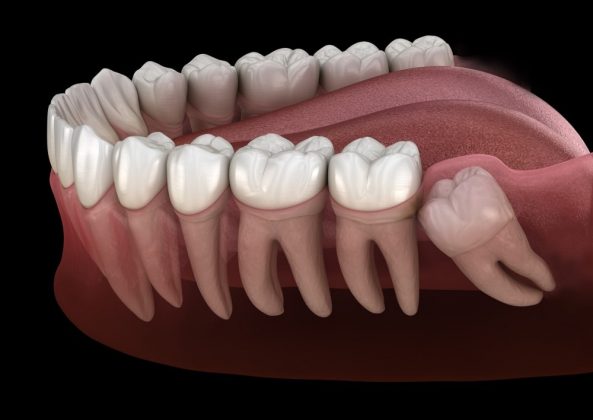 Descubra por que algumas pessoas não têm dentes do siso (Foto: Freepik)