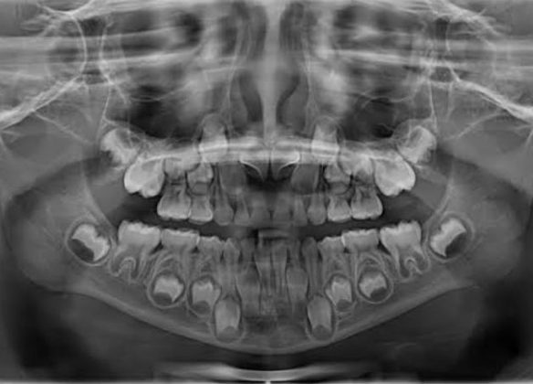 O gene USAG-1 é o foco do estudo para permitir o crescimento de dentes. (Imagem: reprodução instagram)